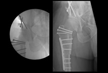 X-ray image of a patient demonstrating fixation of periacetabular osteotomy